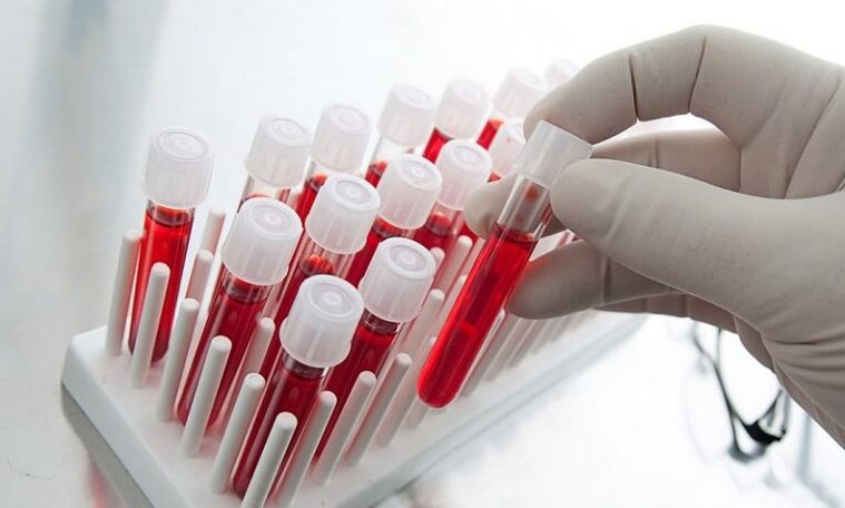 blood in test tubes for analysis of a dog with prostate