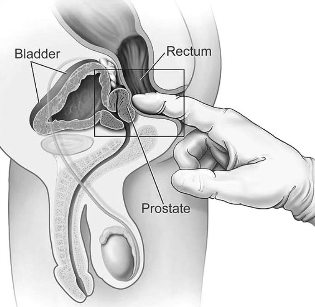 treatment of prostatitis at home massage