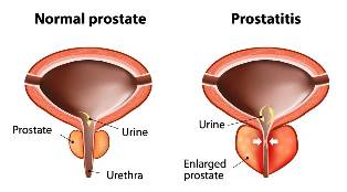 prostatitis acute treatment