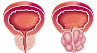reasons for developing prostatitis and prostate adenoma